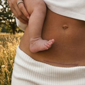 Ožiljak od operacije i bebino stopalo kao simbol pobede nad endometriozom i neplodnošću.